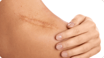 Narbenentstörung nach Kapek